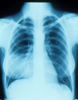 Пневмония в правой средней доле с исчезновением определяющегося контура анатомической структуры на рентгенограмме
