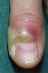 Akute Paronychie am Finger