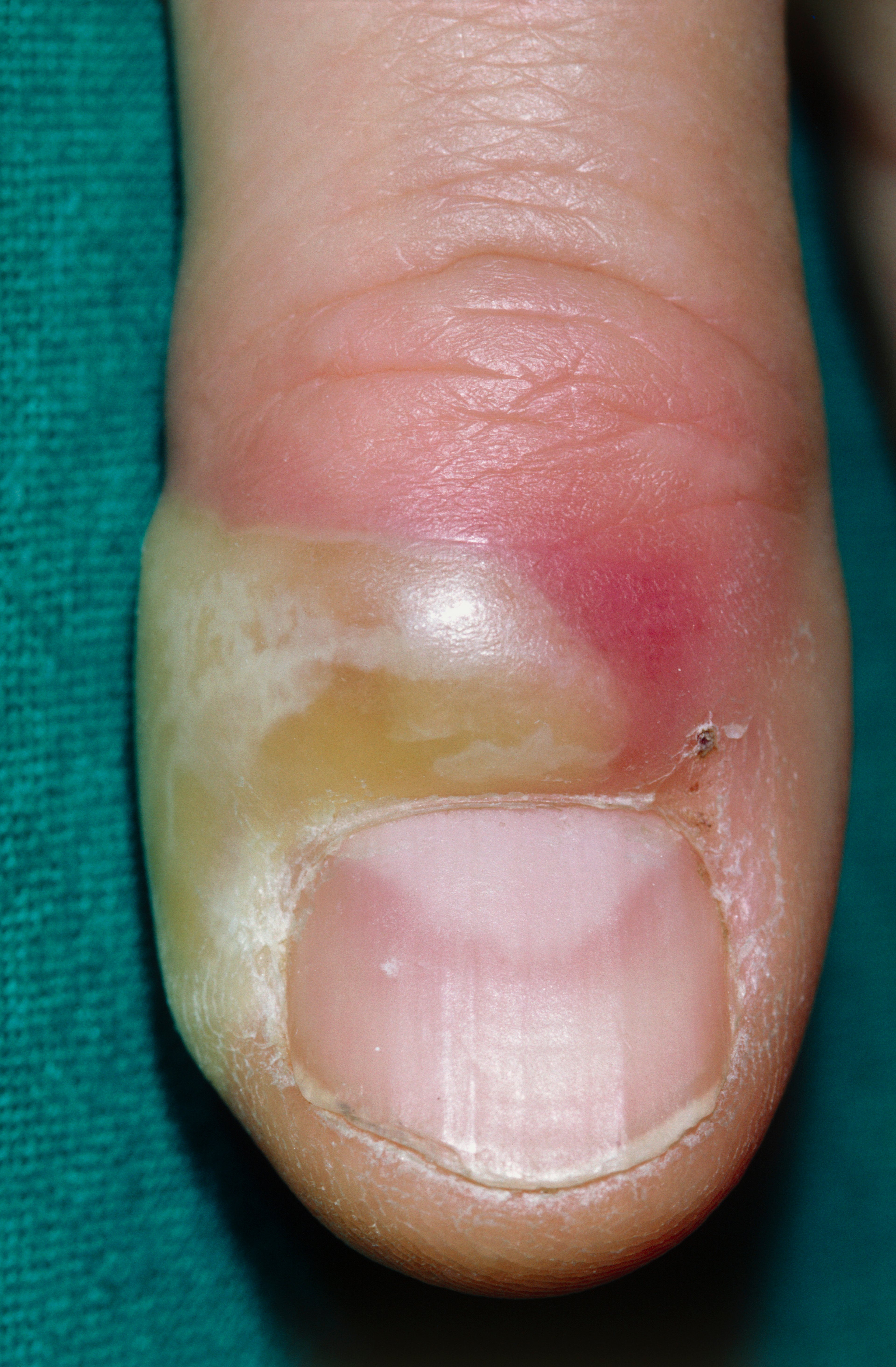 手指の急性爪囲炎
