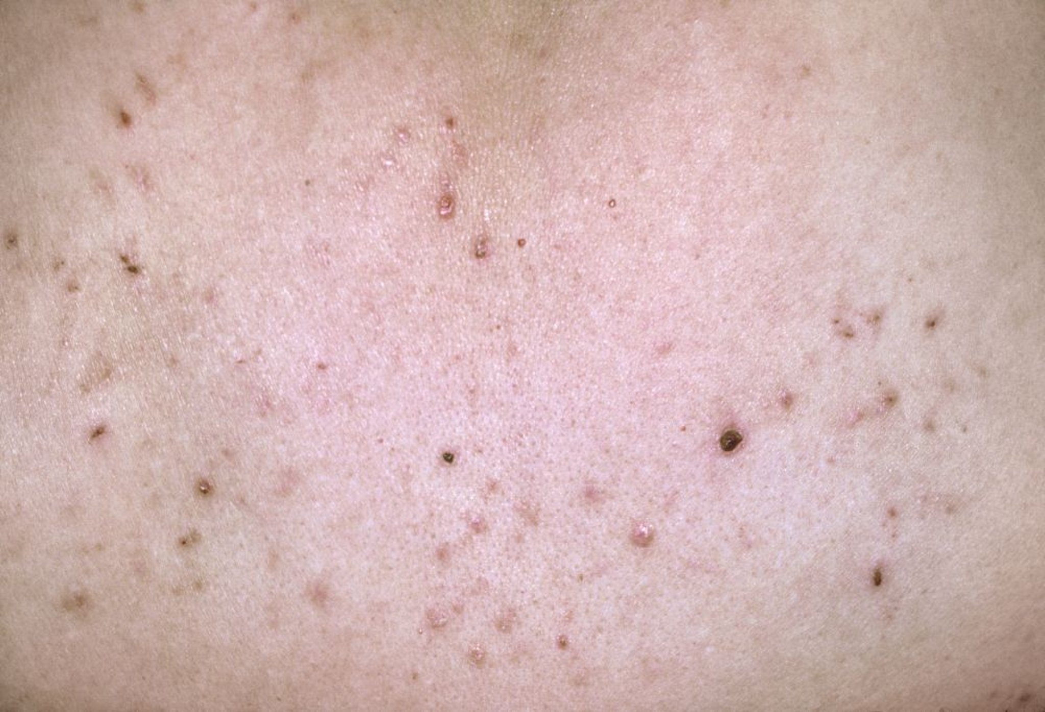 Pityriasis lichénoïde aiguë