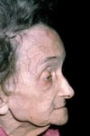 Frontal Bossing in Paget Disease