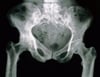 Radiograph of the Pelvis in Paget Disease