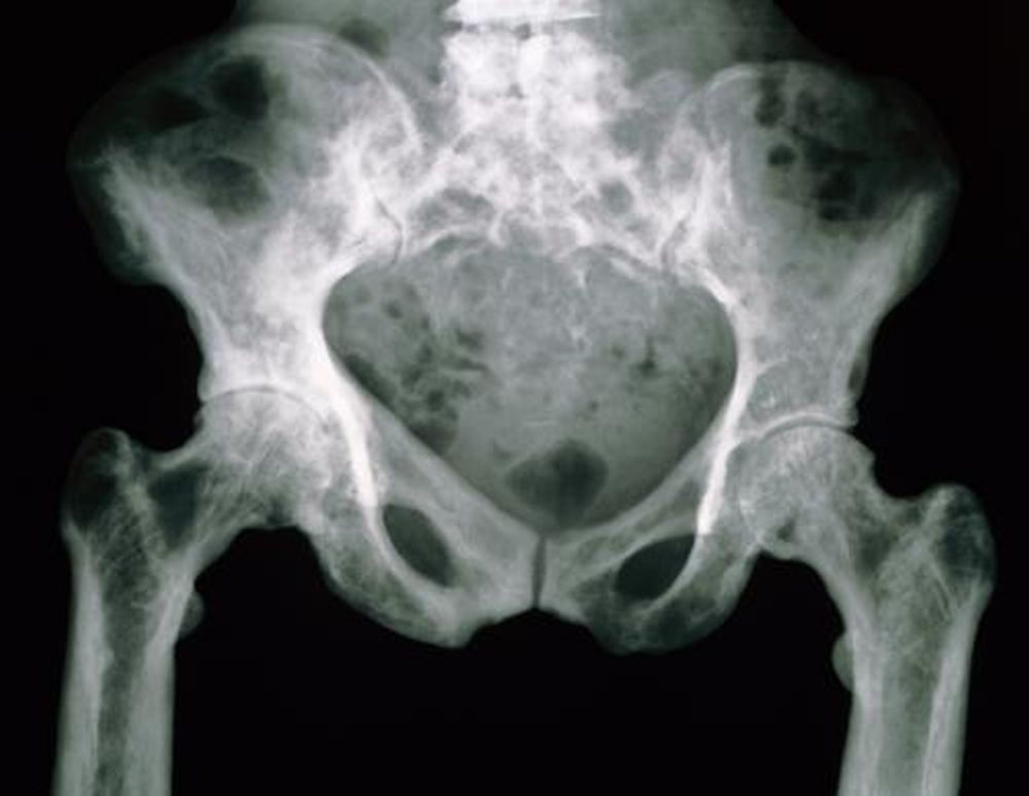 Radiografía de la pelvis en la enfermedad de Paget