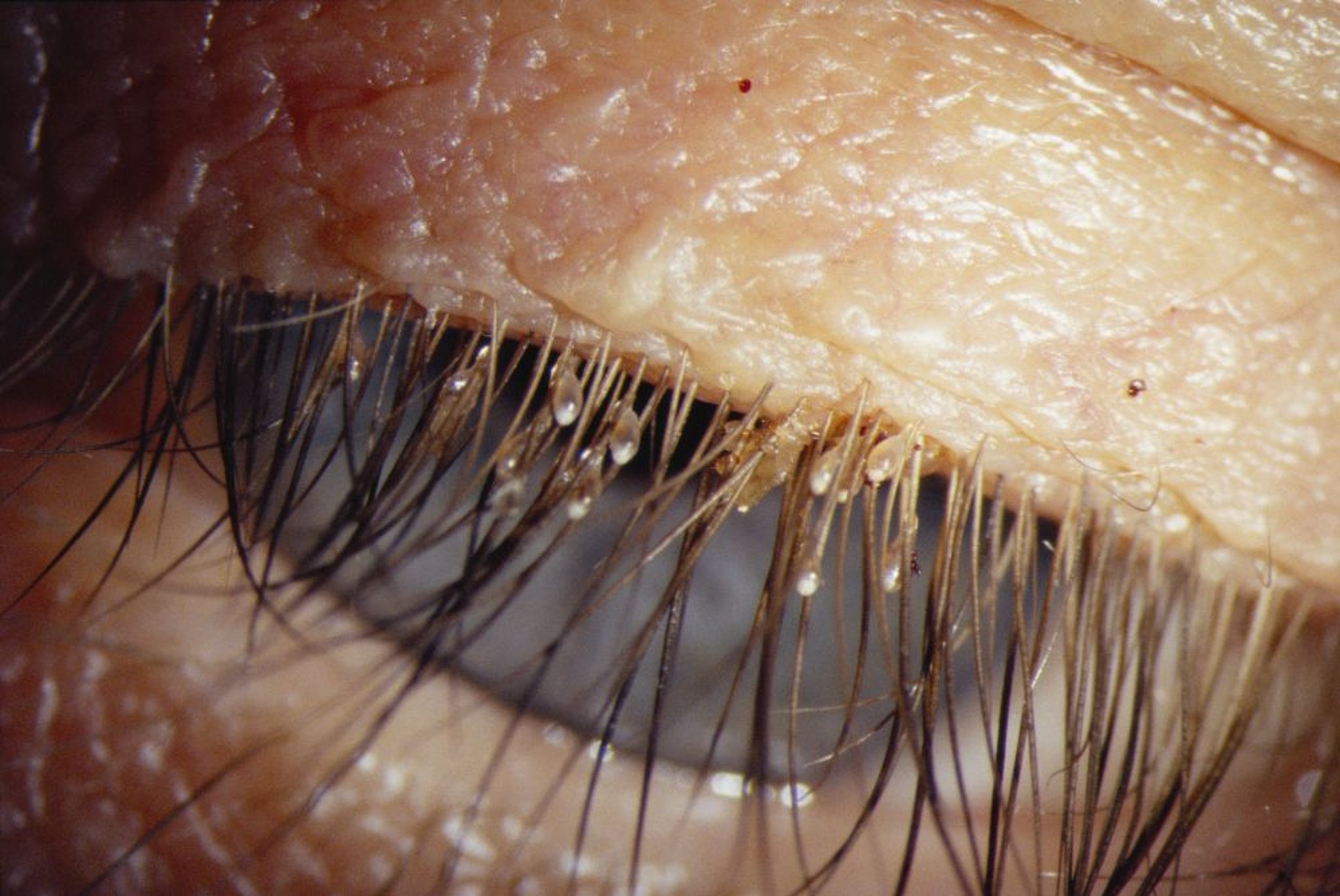 Poux sur les cils