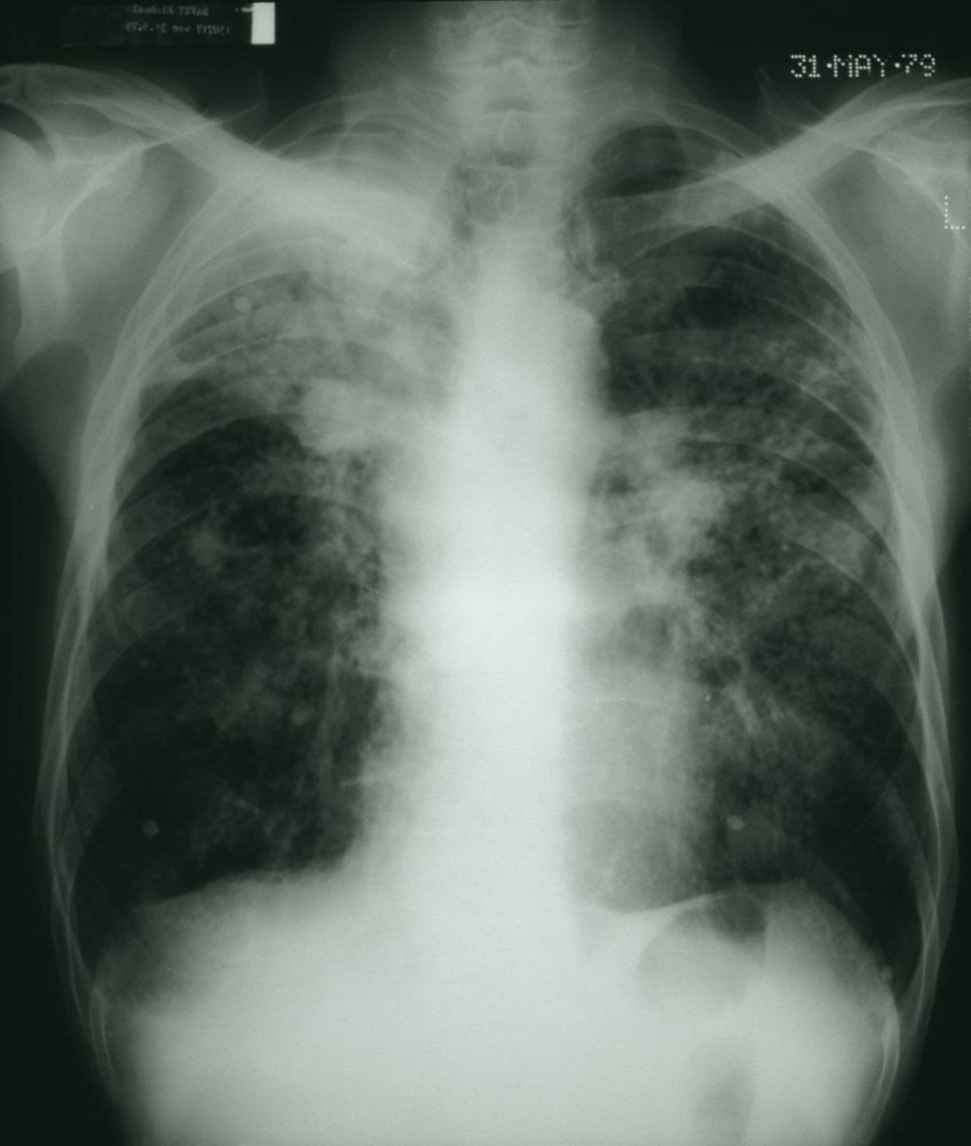 Pneumoconiosis