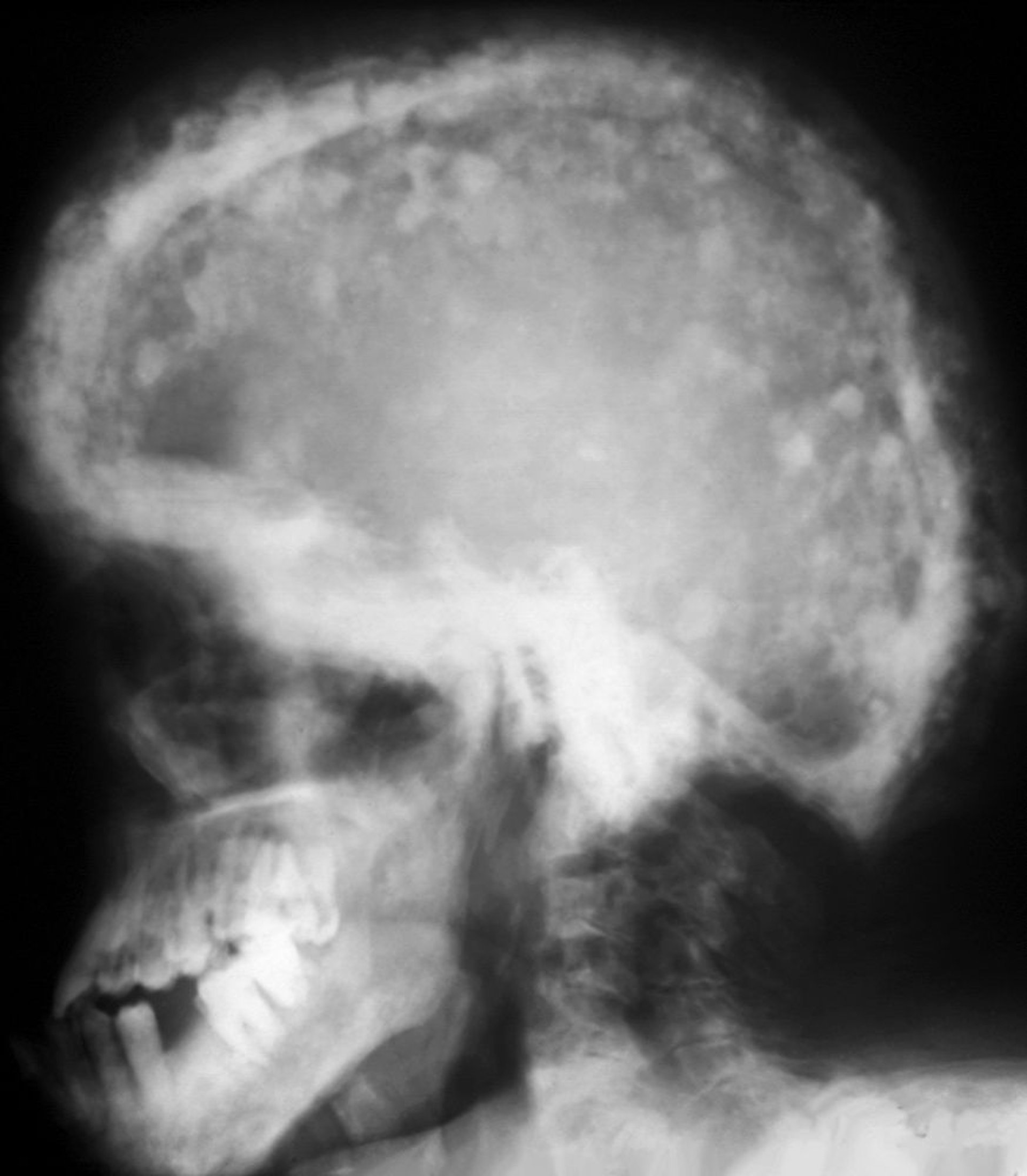 Röntgenaufnahme des Schädels bei Morbus Paget