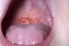 Petechiae (Hard Palate)