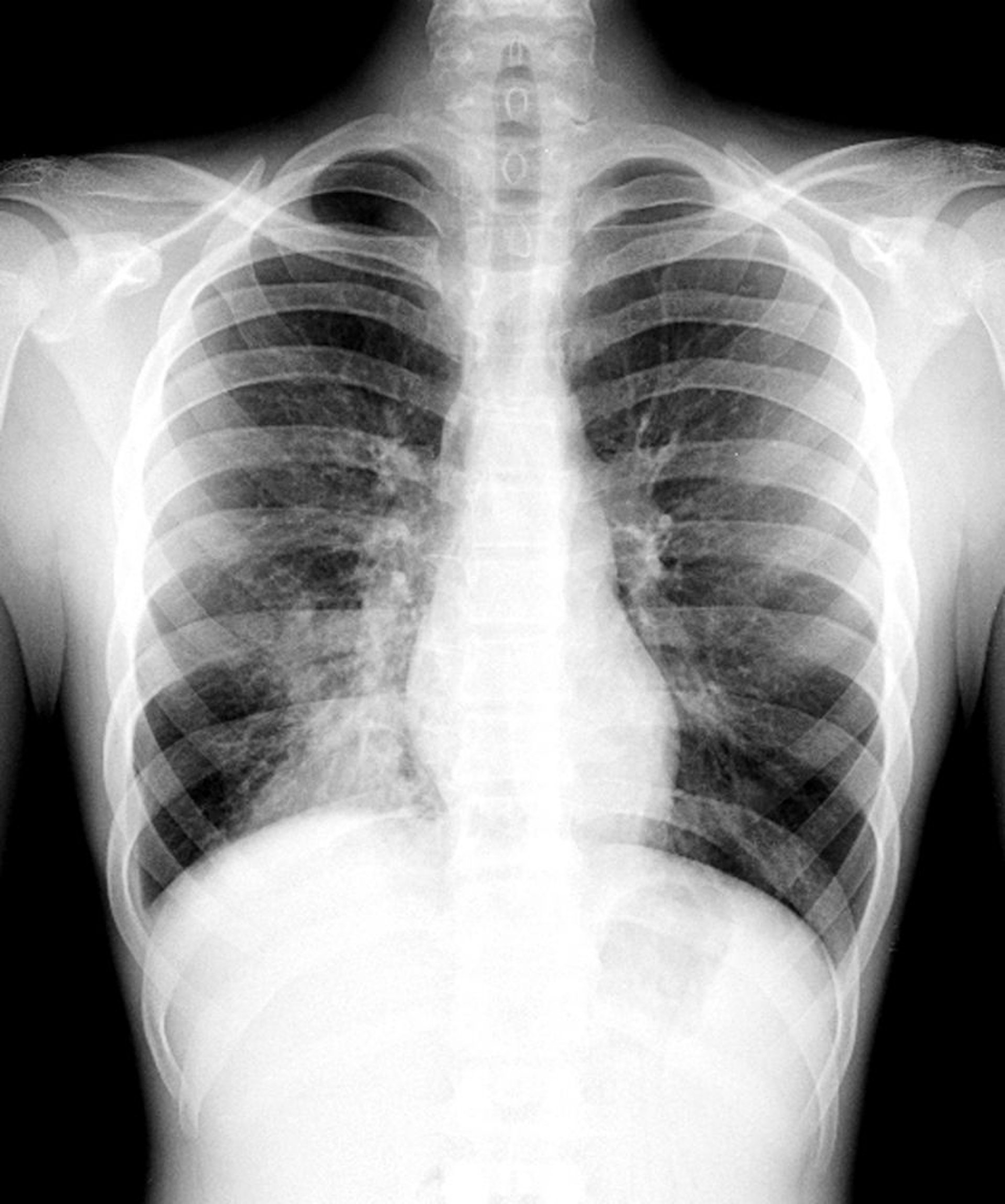 Pneumonie des rechten Unterlappens