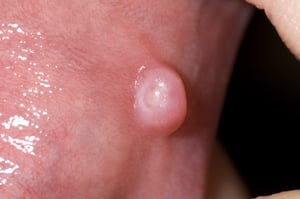 Benign Oral Growth (Irritation Fibroma)
