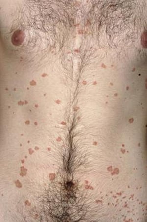 Psoriasis en gotas