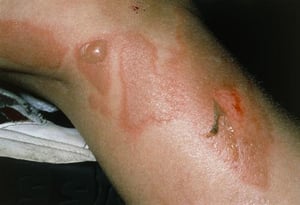 Sindrome della cute ustionata da stafilococco (gamba)