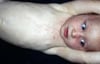Roseola Infantum (Rash)