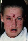 Sindrome di Stevens-Johnson