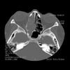 Sinusitis