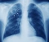 Tuberculose (radiographie de thorax)