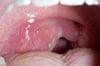 Abscesso peritonsilar com desvio da úvula