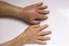 Wasp Sting Reaction