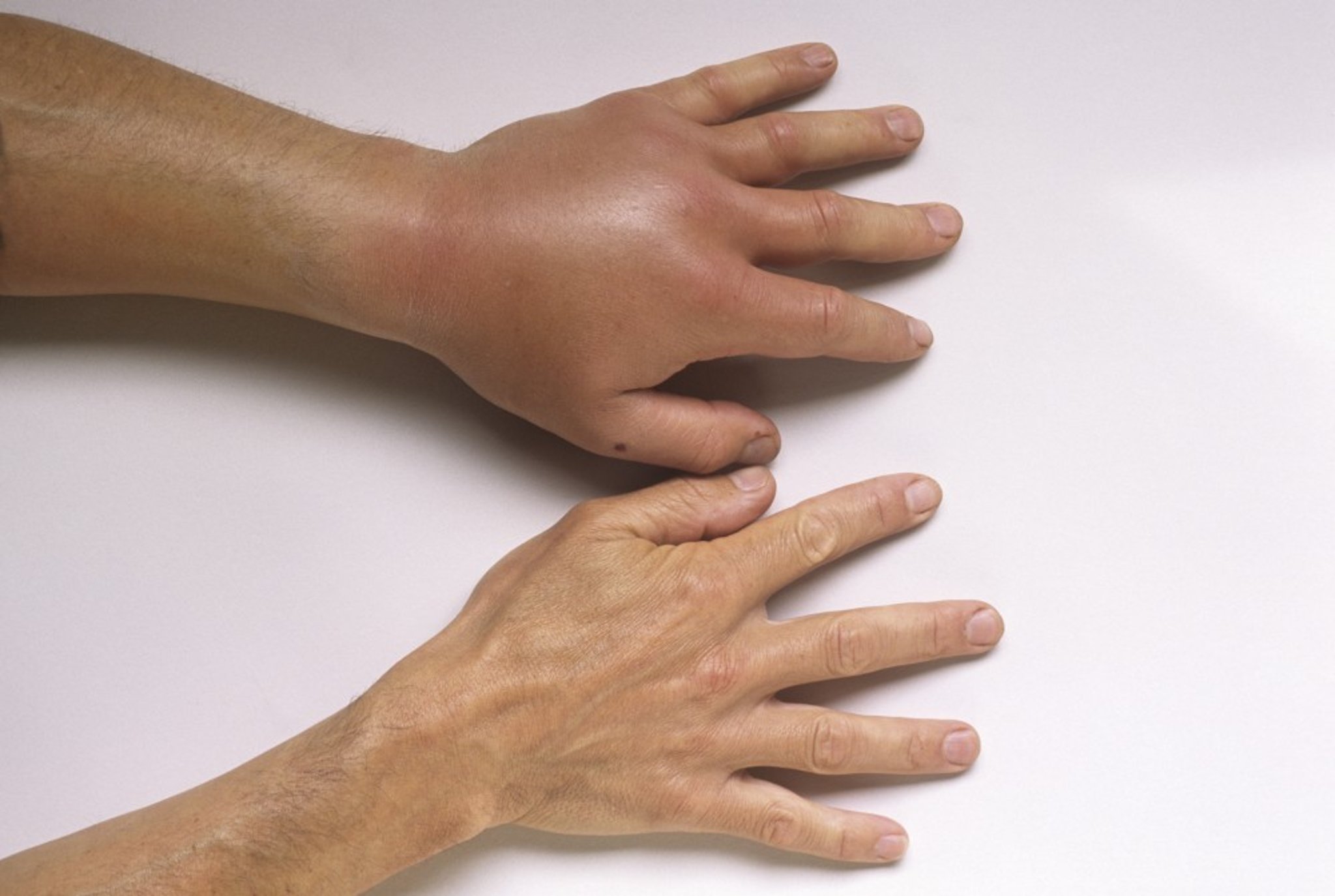 Wasp Sting Reaction