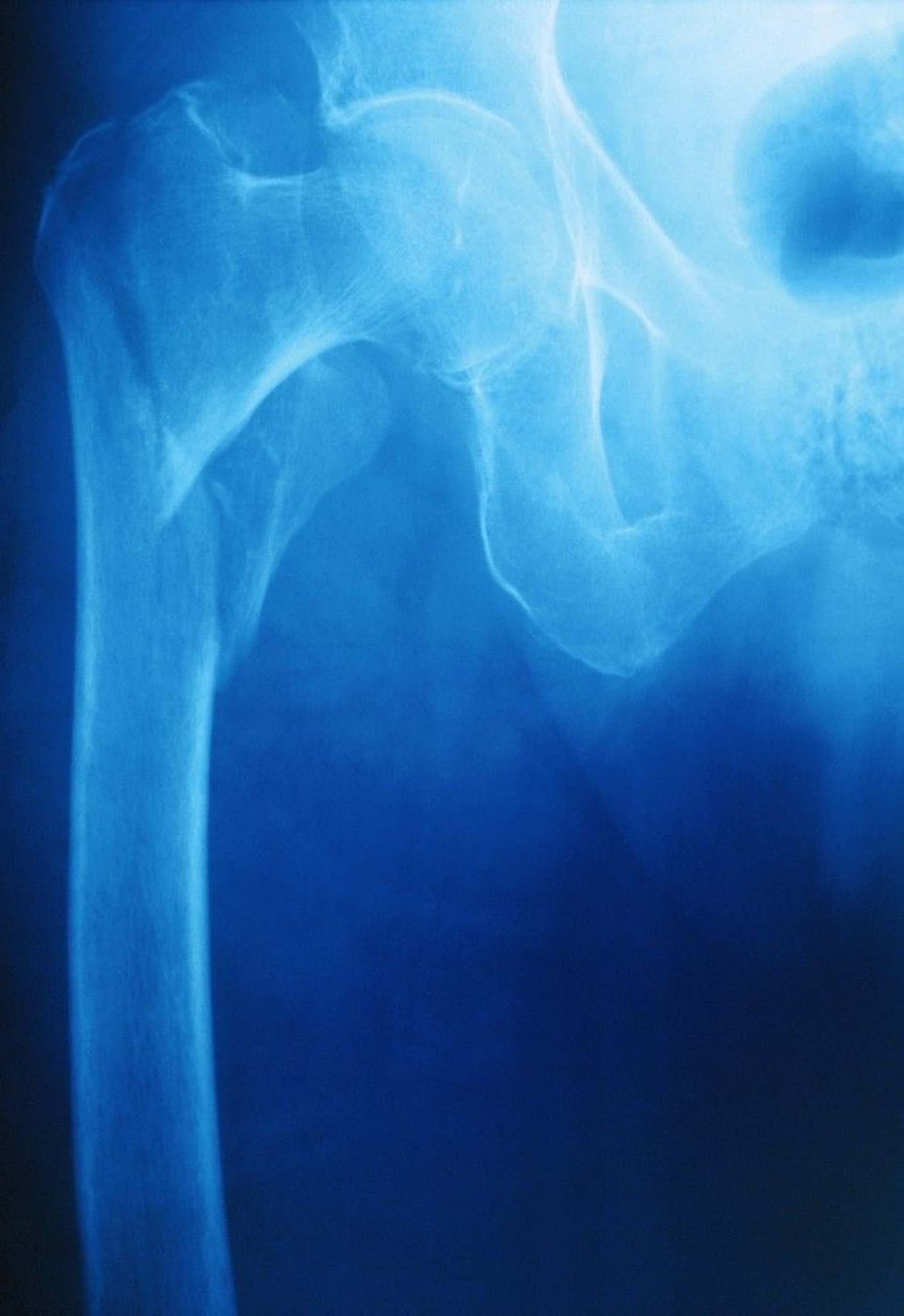 Intertrochanteric Hip Fracture