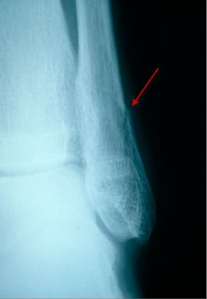 Скрытый перелом дистального отдела малоберцовой кости (вид сбоку)