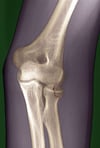 Radial Head Fracture