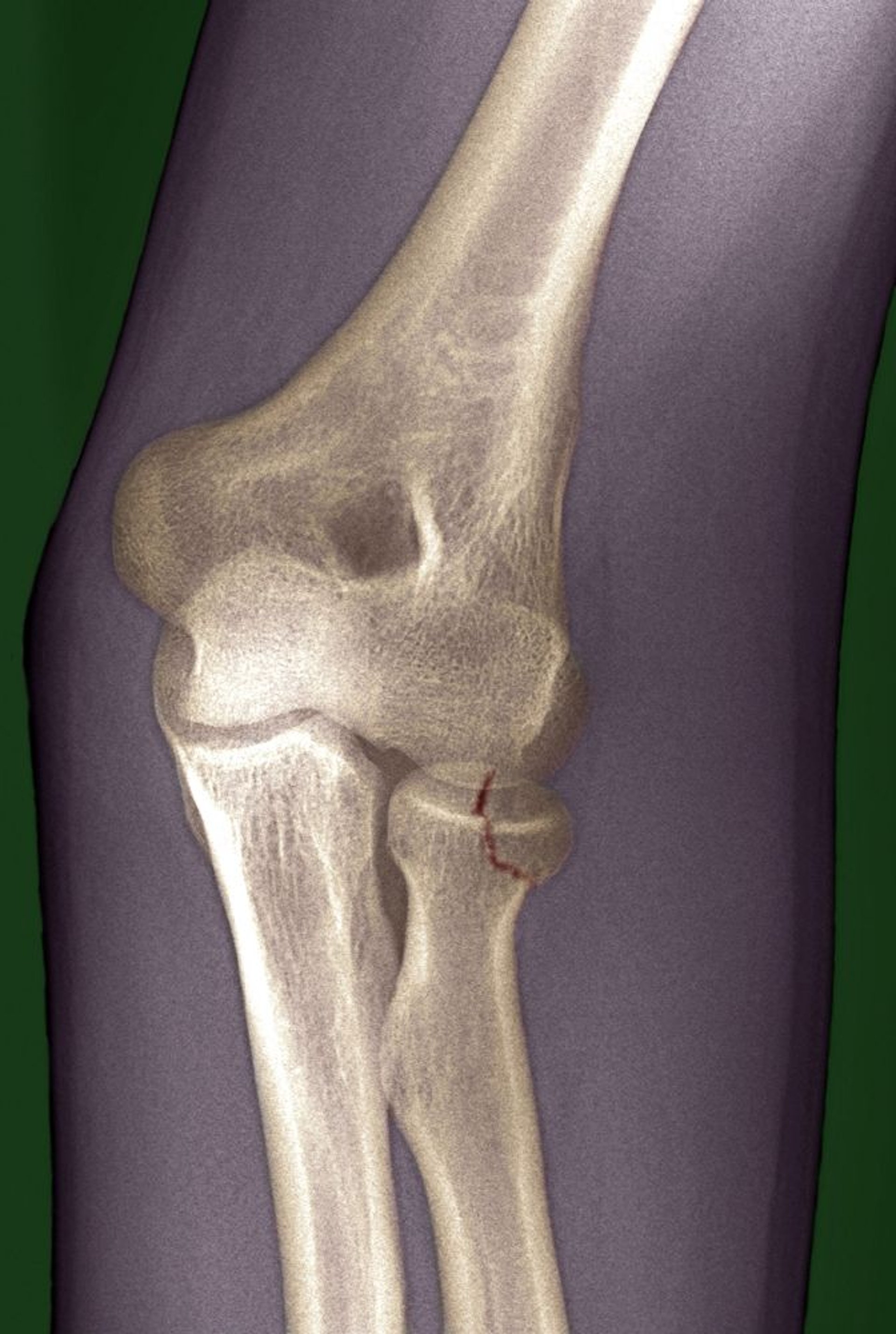 Fracture de la tête radiale