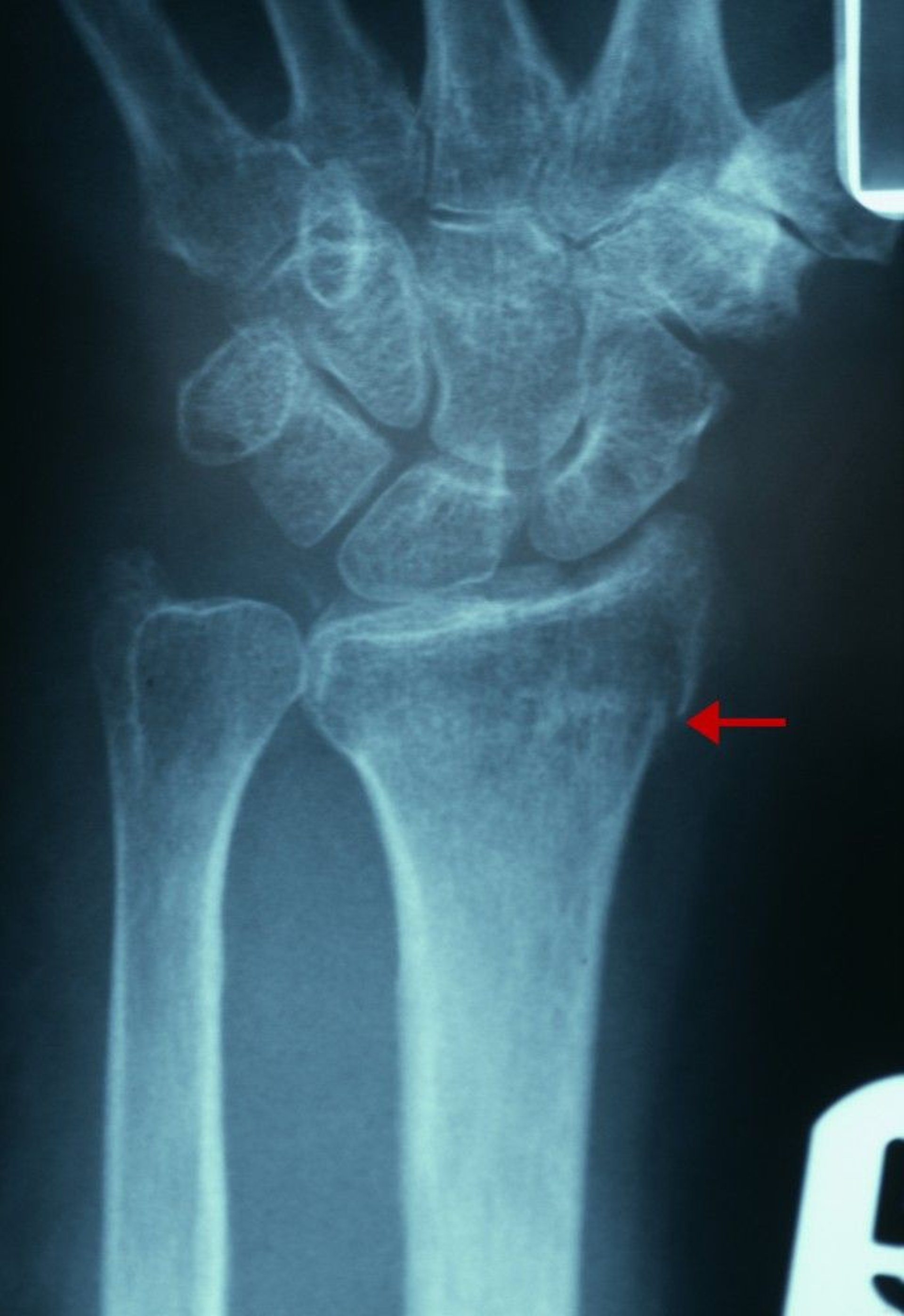 Subtle Distal Radius Fracture
