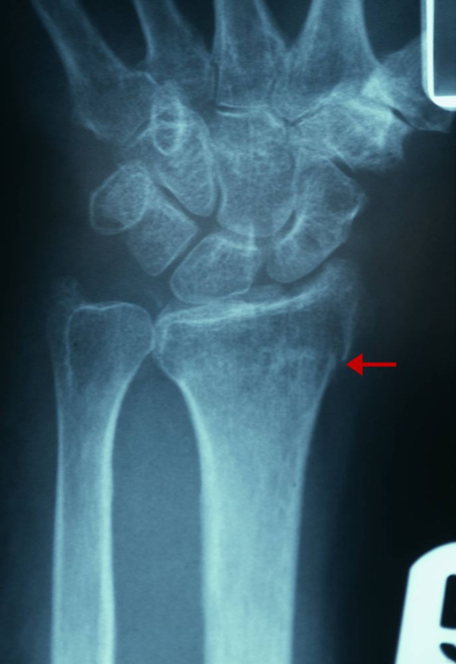 Fracture subtile du radius distal