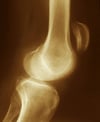 Déchirure du tendon rotulien