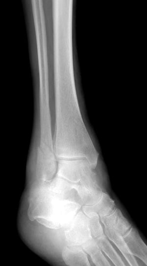 Fracture de la malléole latérale