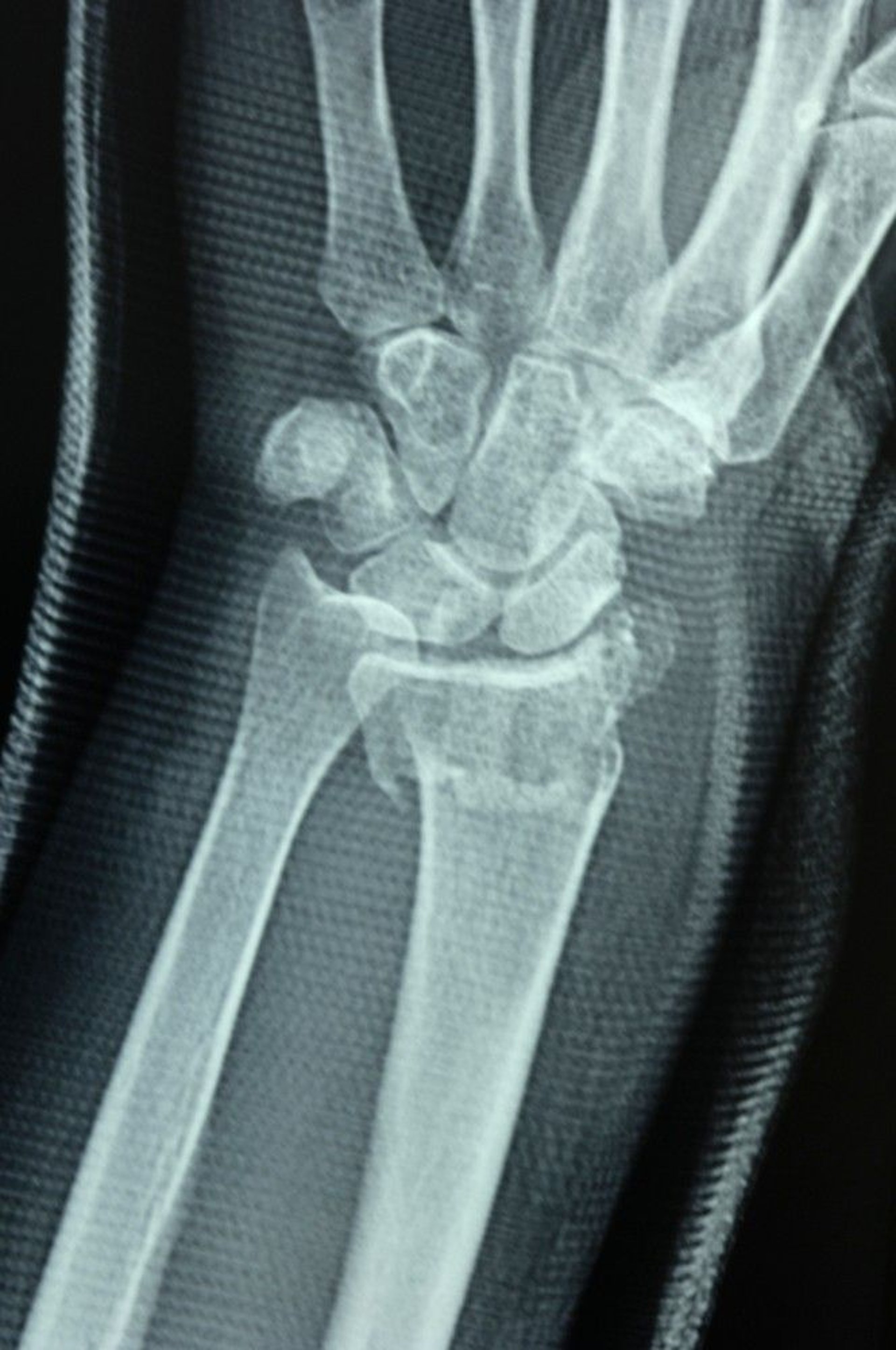 Distal Radius Fracture