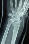 Fractura distal del radio