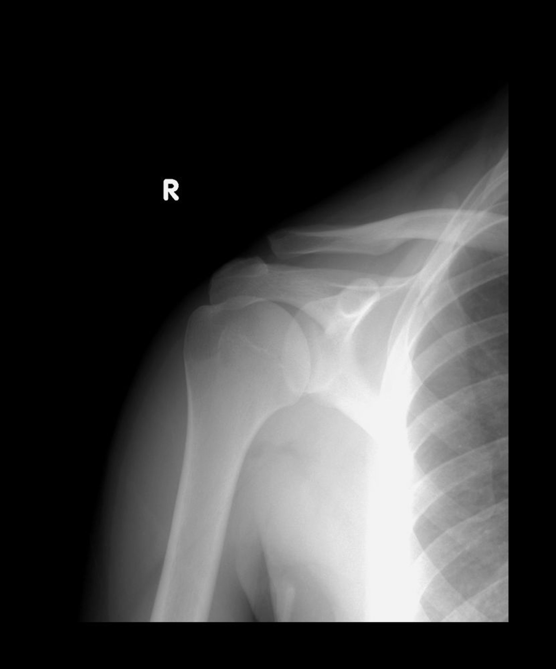 Estiramento da articulação acromioclavicular