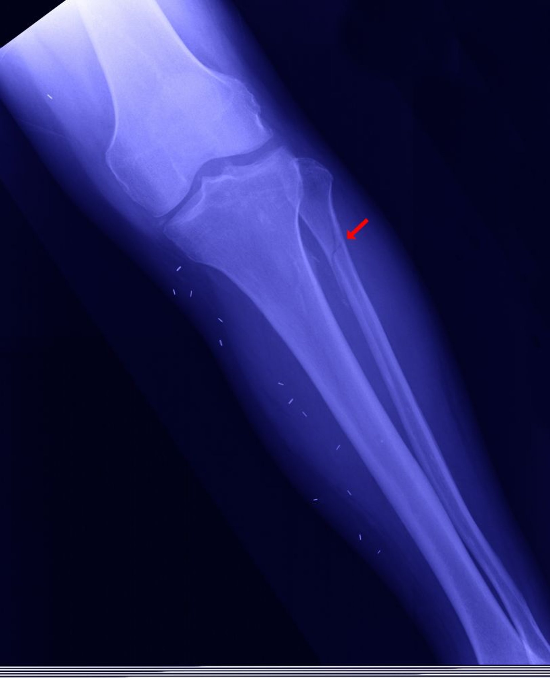Fractura proximal del peroné