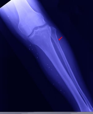 腓骨近位端骨折