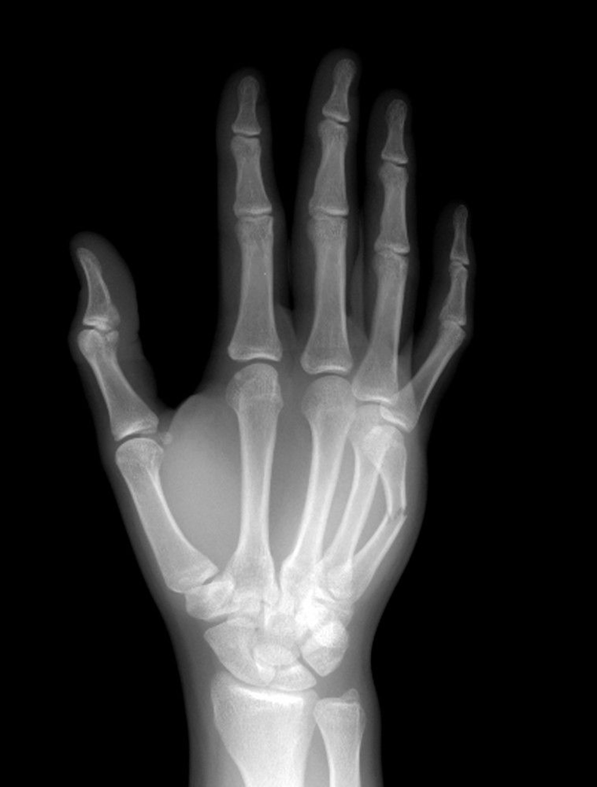 Metacarpal Neck Fracture