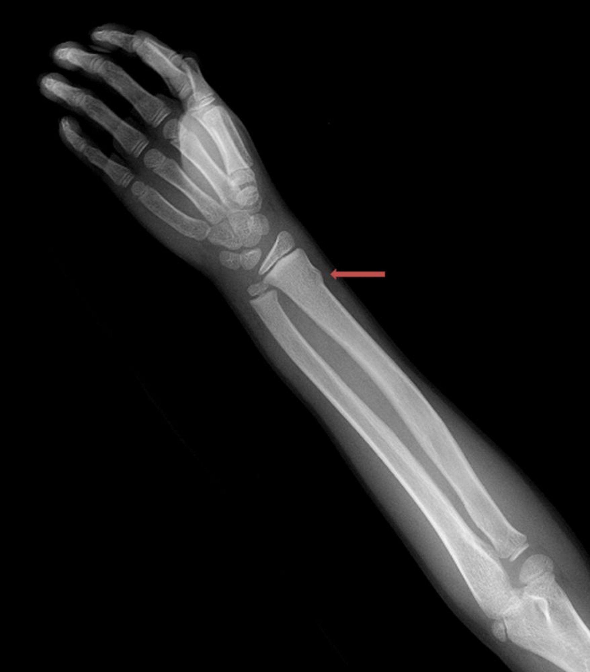 Fractura de la muñeca en rodete (torus)