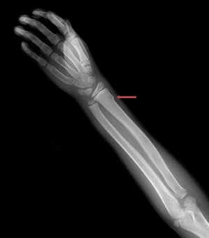 Fractura de la muñeca en rodete (torus)
