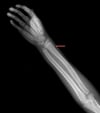 Fracture du poignet en motte de beurre