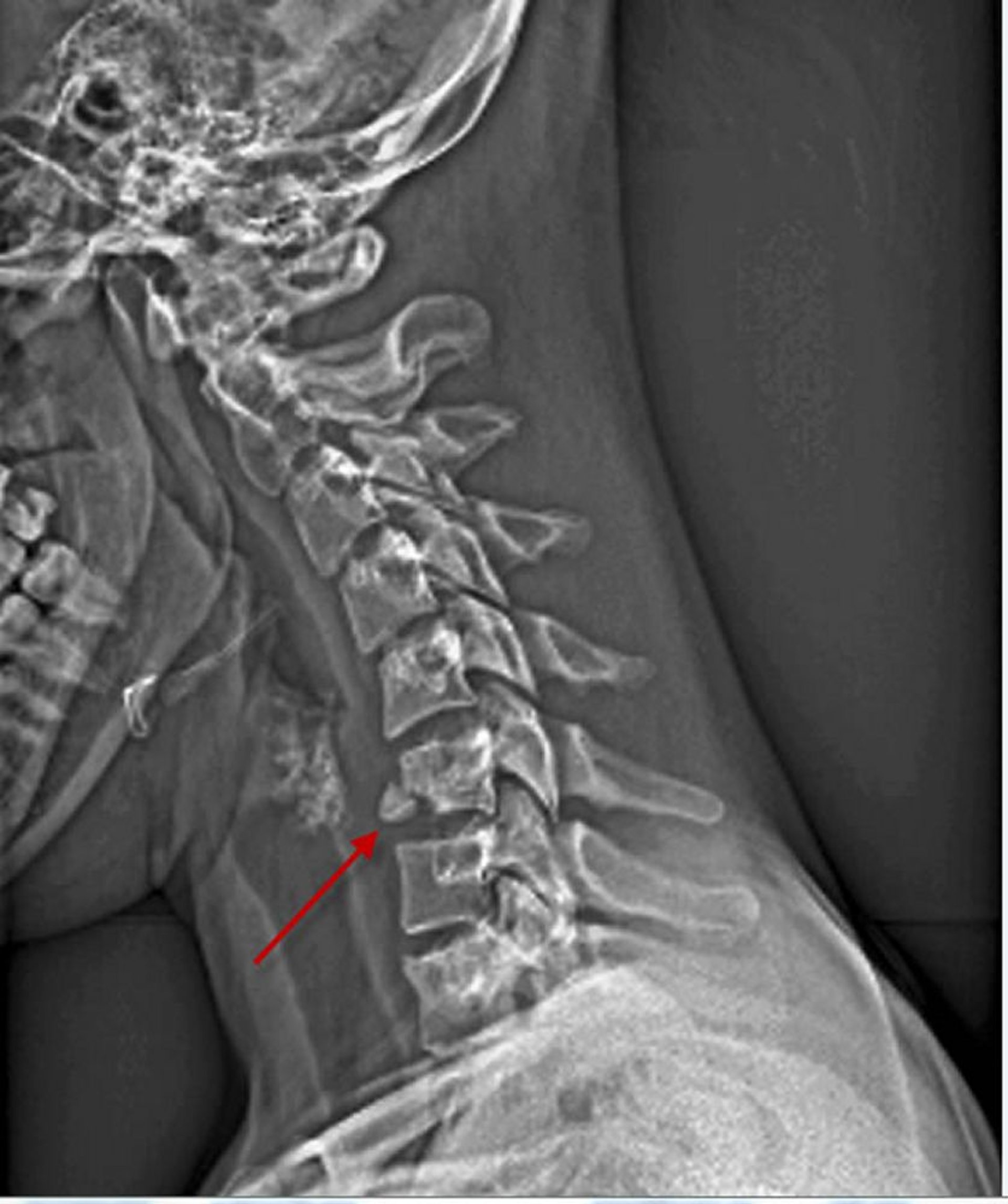 Fracture du corps vertébral cervical