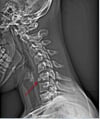 Frattura della vertebra cervicale