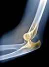 Posterior Elbow Dislocation