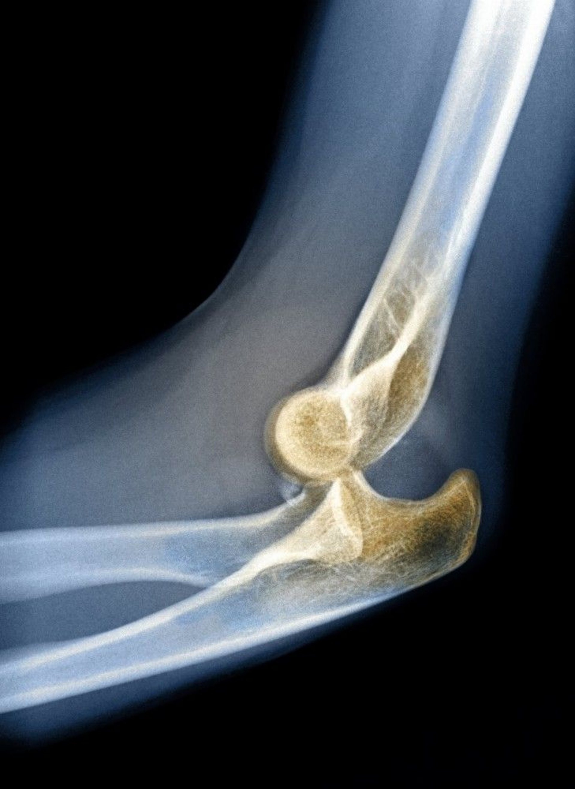 Posterior Elbow Dislocation