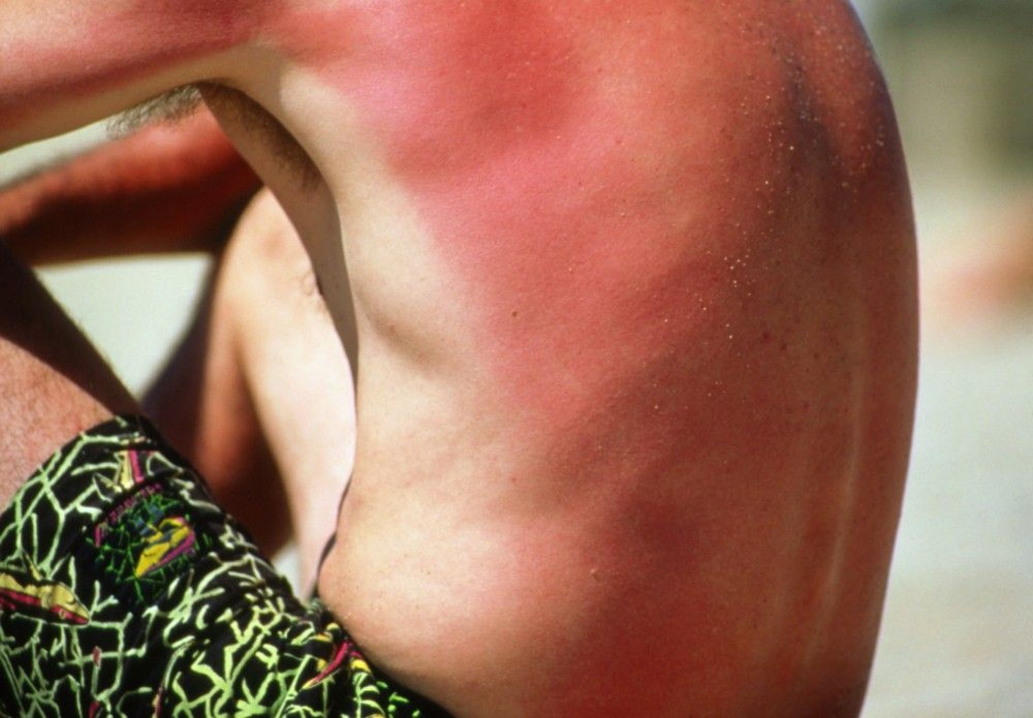 Mild Sunburn