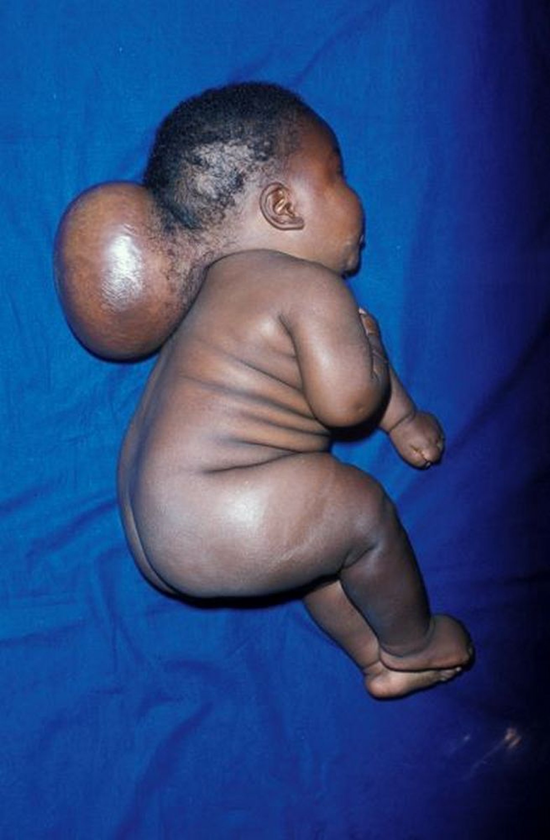 Encephalocele