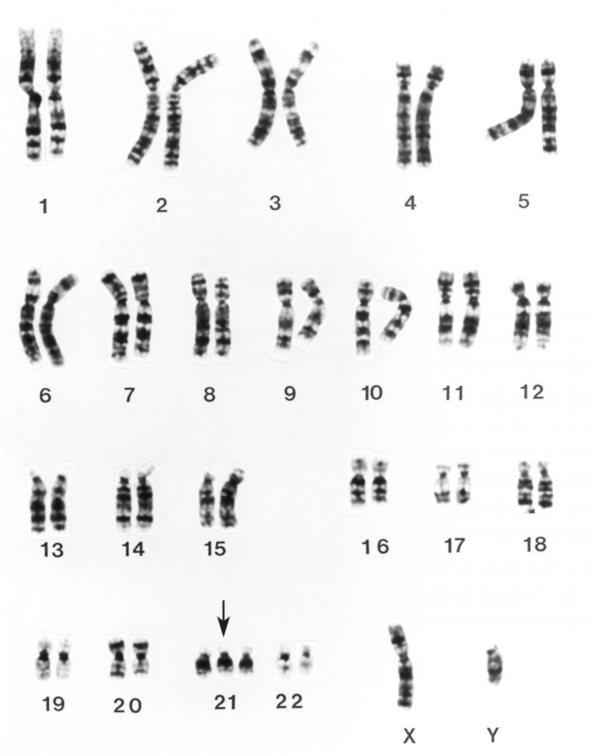 Down Syndrome Karyotype