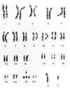 Caryotype du syndrome de Down