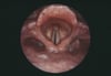 Vocal Cord Paralysis