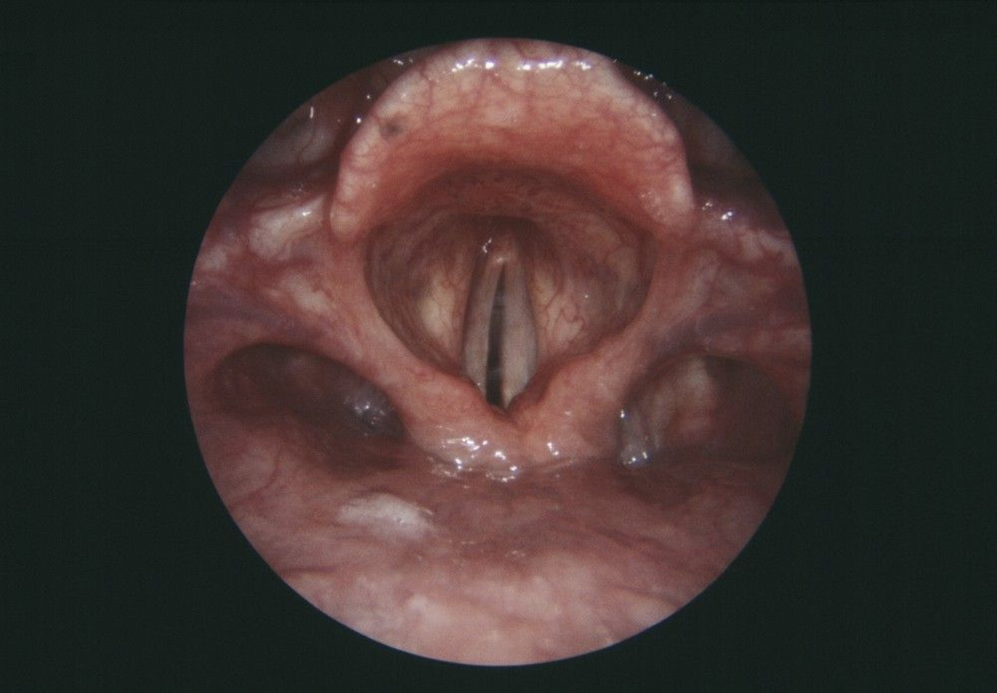 Vocal Cord Paralysis