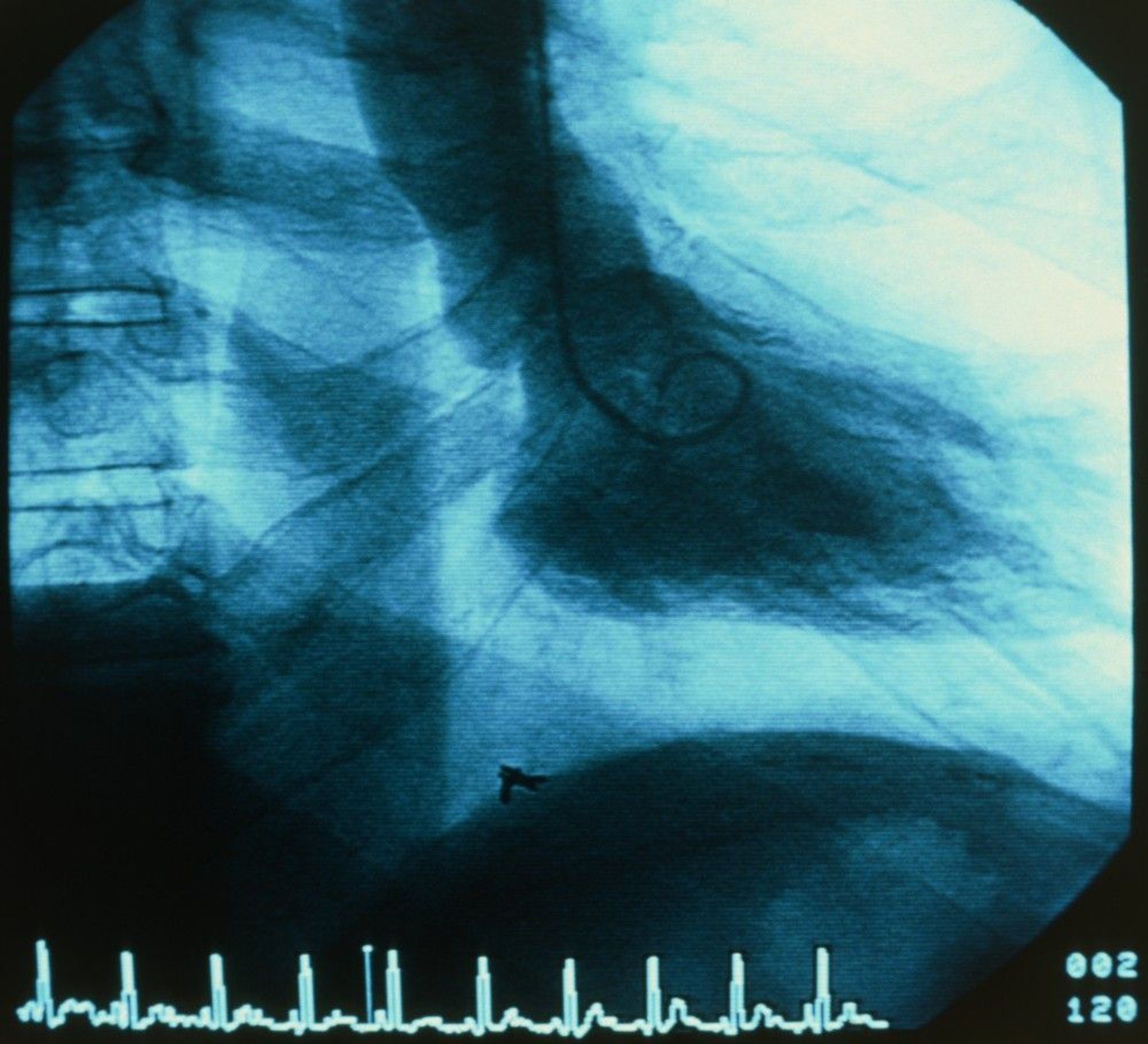 Ventriculography (LV Gram)